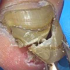 Poor thick onychomycosis, shaped like stairs【Pedicure King】